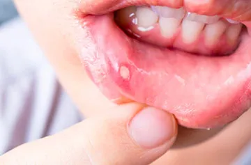 Ulcer în gură - tratament medical și la domiciliu