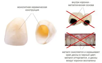 Protezele din ceramica, timp de 2 ore pe zi vizita! proteze dentare ceramice-metal liber