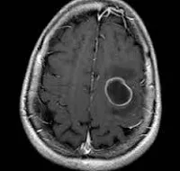 Brain abces - cauze, simptome, diagnostic și tratament