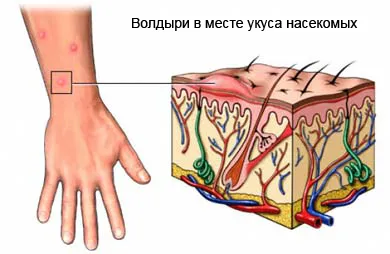 Алергичен за лечение комар, симптоми и диагностика