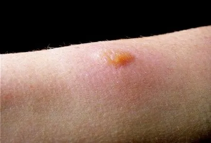 Az allergia bőrteszt, hogy egy gyermek, hogy ez lehetséges, hogy nem Mantoux teszt, allergia, ha a gyermek allergiás,