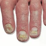 Атрофия ноктите видове заболявания, методи за лечение,