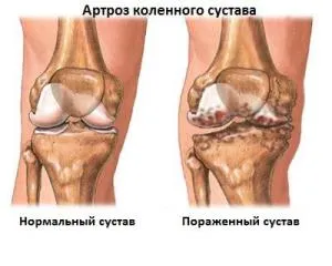 Остеоартрит на коляното (гонартроза) - Лечение и симптоми