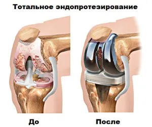 Остеоартрит на коляното (гонартроза) - Лечение и симптоми