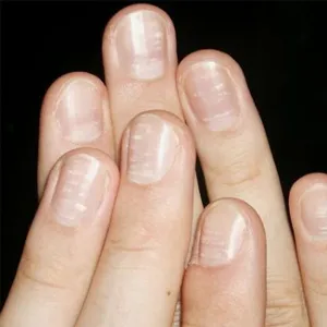 Атрофия на ноктите и gipertorofiya причини и лечение на