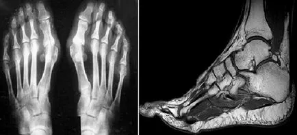 Osteoarthritis tünetek és a kezelés a ragadós interphalangealis ízületek és a gyógyszeres kezelés otthon