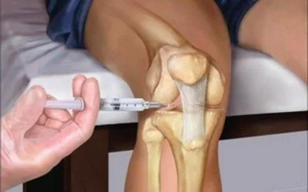 Osteoartrita a simptomelor genunchi si tratament