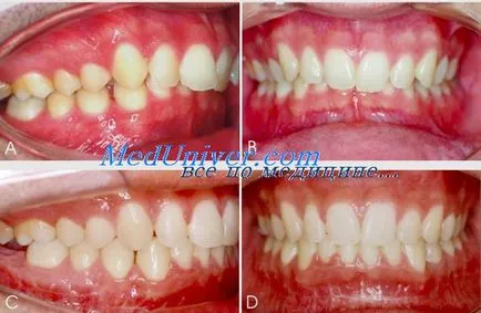 Tratamentul instrumental al malocclusion