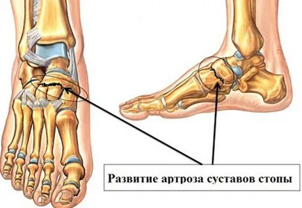 Osteoarthritis tünetek és a kezelés a ragadós interphalangealis ízületek és a gyógyszeres kezelés otthon