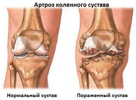 Остеоартрит на коляното и симптомите на лечението