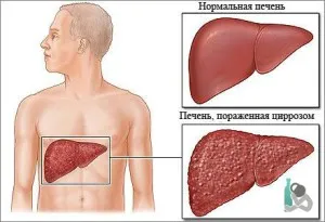 Заболяванията от алкохол