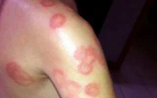 A plakk psoriasis - tünetek és a kezelés, a megjelenést (fénykép)