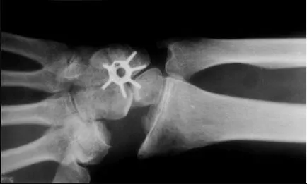 Kienbock de tratament a bolii, simptome si diagnostic