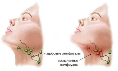 Citomegalovirus femei ce este, simptome si tratament al bolii la adulti, astfel cum a raportat