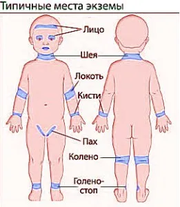 Екзема в детските симптоми, причини и лечение