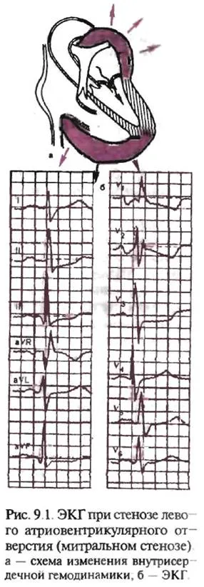 Elektrokardiogram stenosis balra-rioventrikulyarnogo lyukak (mitrális stenosis)