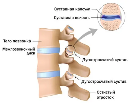 Evdokimenko arthrosis, enyhíti az ízületi fájdalom örökre
