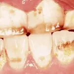 Cauzele fluorozei dentare, de simptome și tratament