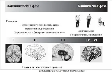 Болест на Паркинсон форми - твърди, съдова паркинсонизъм, ранни и крайни етапи