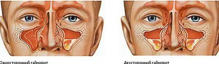 Синузит пункция и последиците могат да бъдат излекувани, без да се прави пункция, пункция на носа, боли