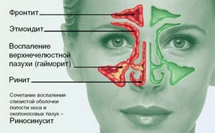 Az orrmelléküreg-gyulladás szúrás és a következmények is gyógyítható nélkül defekt készül, a szúrás az orr, fáj