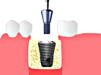 Implantarea, dentare Centrul de implantologie „Cupidon implant“