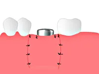 Implantarea, dentare Centrul de implantologie „Cupidon implant“