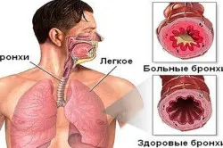 Инфекциозни симптоми и лечение на астма