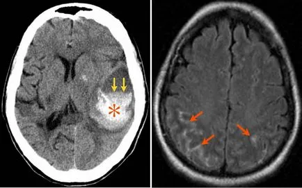 Ischaemiás stroke, vérzéses impregnáló