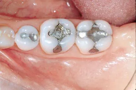 Какво прави един печат зъб, съставът на двете постоянни и временни тип
