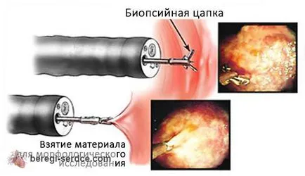 Биопсия на миокарда, тъй като има над провежда и какви са резултатите