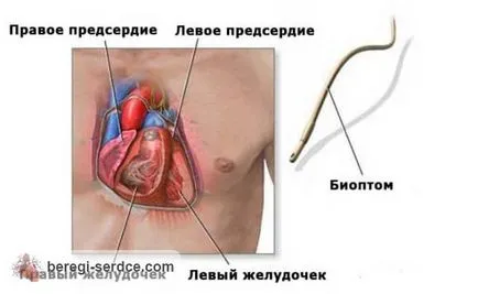 Биопсия на миокарда, тъй като има над провежда и какви са резултатите