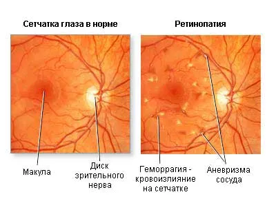 Как диабет засяга очите