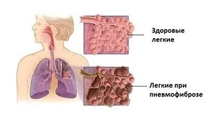 Cum de a trata schimbarile fibrotice in plamani, cauzele de fibroza - trăiesc sănătos