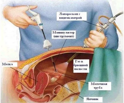 Hogyan lehet azonosítani a méhen kívüli terhesség, mi időszakban lehet ismerni