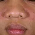 Капилярите по лицето - как да се отървете
