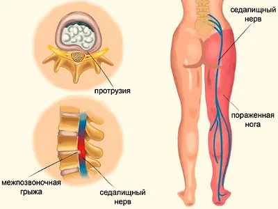 Durere în mușchii picioarelor de mai sus genunchii și șoldurile spre stânga, dreptul femeilor cauze si tratament