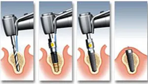 Clasic implantare în două etape