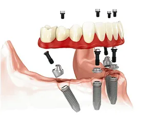 Clasic implantare în două etape