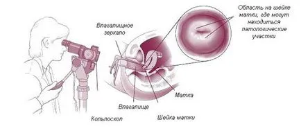 Colposcopia - rănit într-adevăr