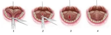 Rövid nyelv frenulum a gyermeknek, hogyan kell azonosítani ankyloglossia korrekciós eljárások