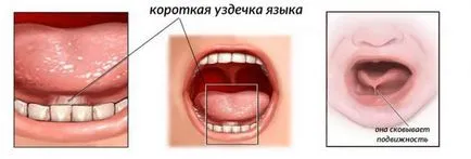 Къса юздичка на езика на детето как да се идентифицират ankyloglossia, методи за корекция