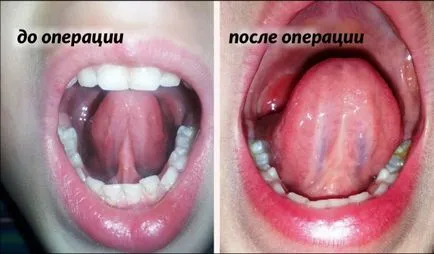 Къса юздичка на езика на детето как да се идентифицират ankyloglossia, методи за корекция