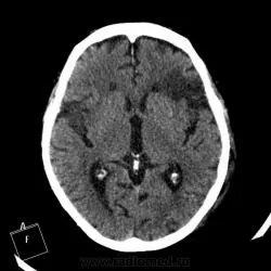 CT на мозъка