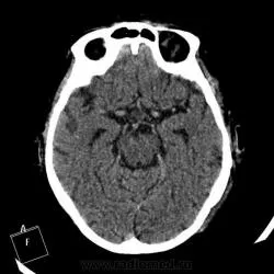 CT на мозъка