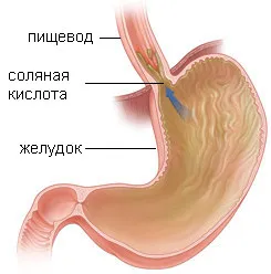 ГЕРБ води и симптоми