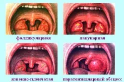 Tratamentul de amigdalită folicular