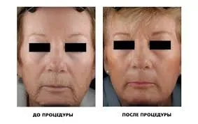 resurfacing cu laser a feței cu recenzii, fotografii înainte și după, contraindicații și reabilitare după procedura