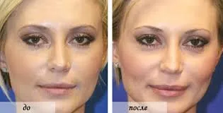 resurfacing cu laser a feței cu recenzii, fotografii înainte și după, contraindicații și reabilitare după procedura