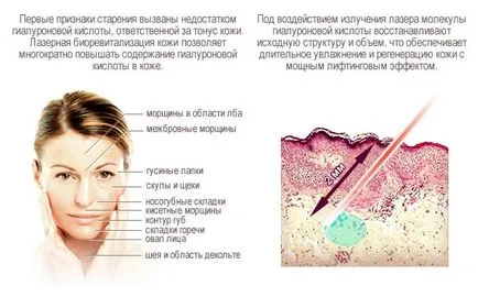 recenzii Biorevitalizare laser, fotografii înainte și după, contraindicații